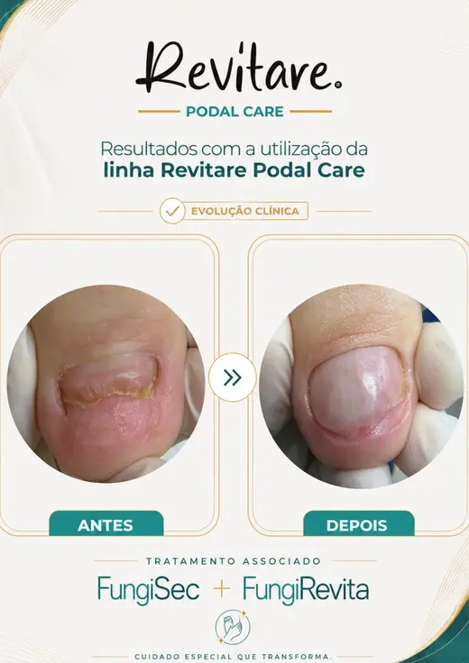 Antes e depois de unha do hálux com descolamento amarelado, depois com a lâmina limpa e o leito rosado