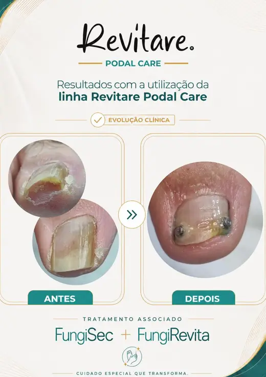 Antes e depois de unha espessada e esfarelando, depois com a lâmina reconstruída