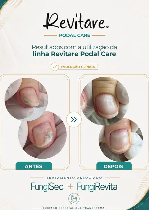 Antes e depois de duas unhas com mancha esbranquiçada, depois com a superfície lisa