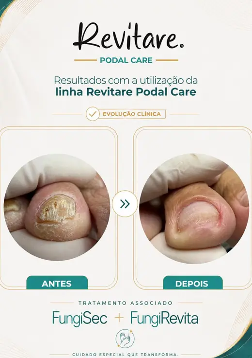 Antes e depois de unha espessa e amarelada, depois com a lâmina fina e clara