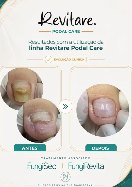 Antes e depois de unha amarelada com descolamento, depois com o leito recuperado