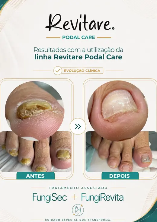 Antes e depois de pé com várias unhas comprometidas, depois com as lâminas clareadas