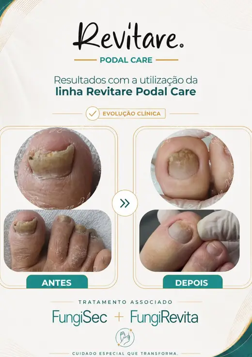 Antes e depois de pé com descamação e unhas escurecidas, depois com a pele e as unhas recuperadas